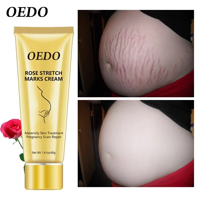 Rose Stretch Marks Cream